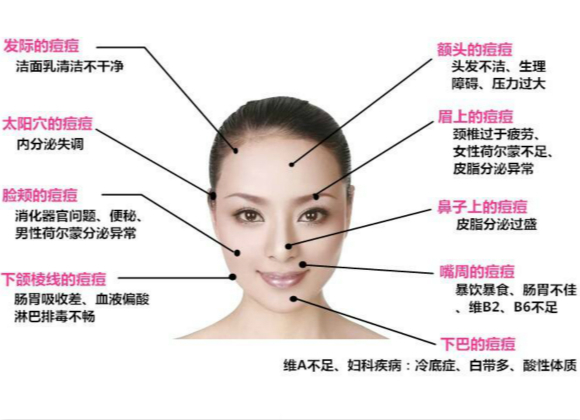 原來這些因素會導致長痘痘！你知道嗎?