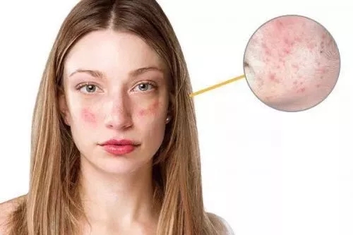 春季過敏不止你一個(gè) 預(yù)防要專業(yè)！