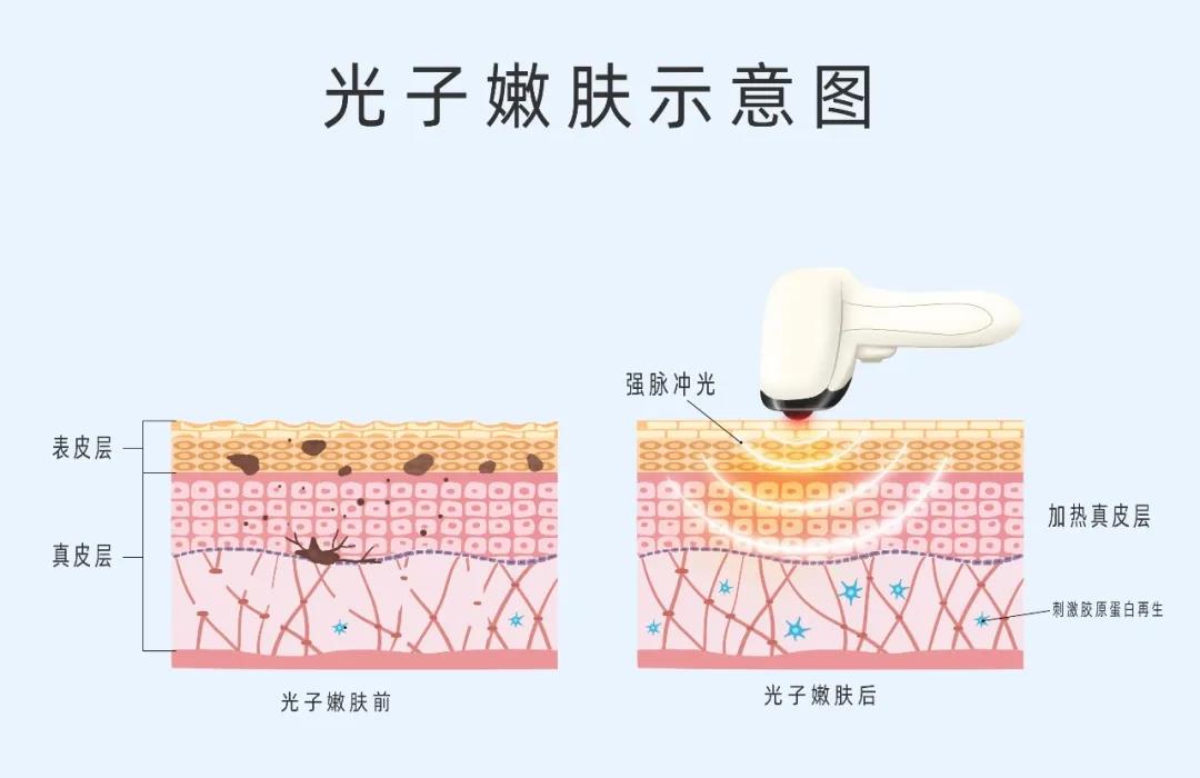 做好術后修復，拒絕“無效醫美”